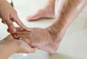 Diabetes Cold Feet Treatment Strategies