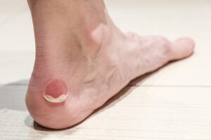 Diabetic Blister Care