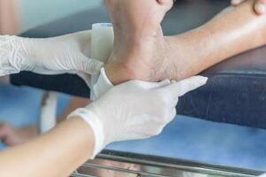 What are Diabetes Leg Ulcers?