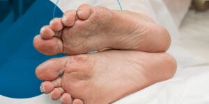 How To Prevent Diabetic Foot?