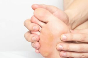 Why Do Diabetics Get Blisters?
