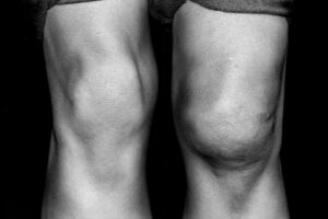Can Diabetes Cause Knee Pain And Swelling?
