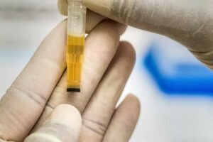 What Are The Reasons Of Ketones In Urine?