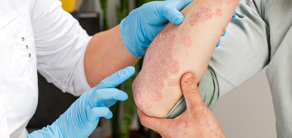 Link Between Diabetes and Psoriasis: Effective Treatment Approaches
