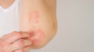 The Diabetes-Psoriasis Connection