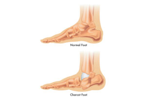 What is Charcot Foot?