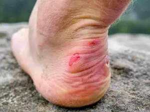 How To Prevent Diabetic Blister?