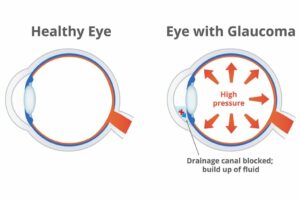 How Diabetes Is Related To Glaucoma?