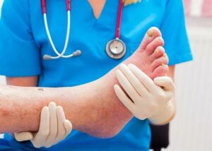 How To Prevent Diabetic Foot?