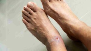 What Causes Diabetic Foot Infection?