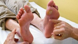 How To Take Care Of Diabetic Foot Ulcers?