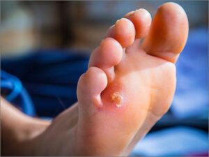 Diabetic Callus treatment