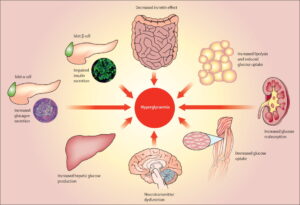 Exploring the Role of Insulin Treatment in Managing Type 2 Diabetes